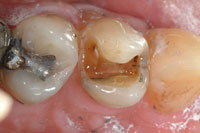 Intra-oral 1 - missing filling