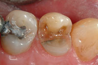 Intra oral 2 - fractured - amalgam