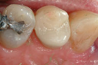 Intra oral 3 - final - restoration Cerec