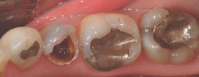 View of fillings at x2 magnification with Microscope Dentistry