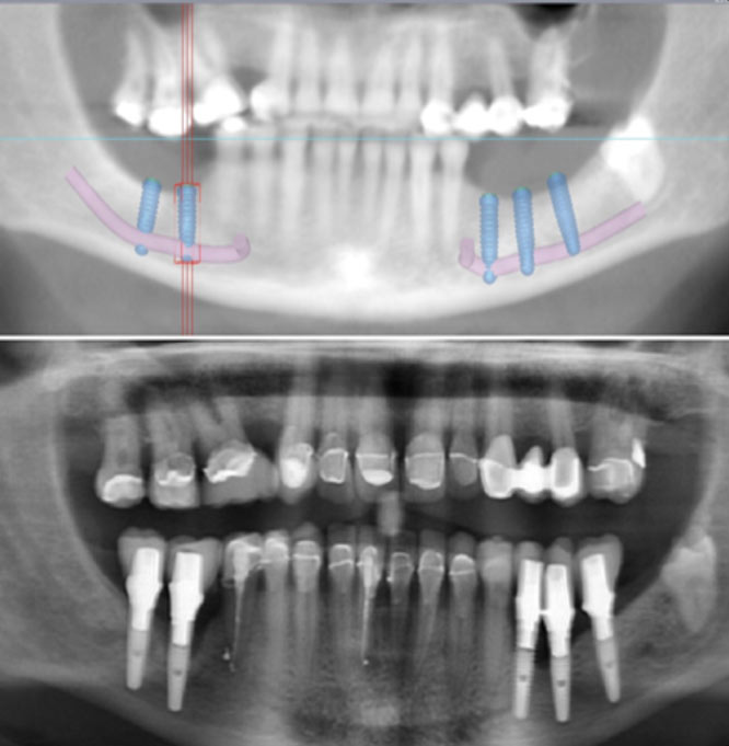 Nerve Laterilsation - Gate Dental Clinic Galway
