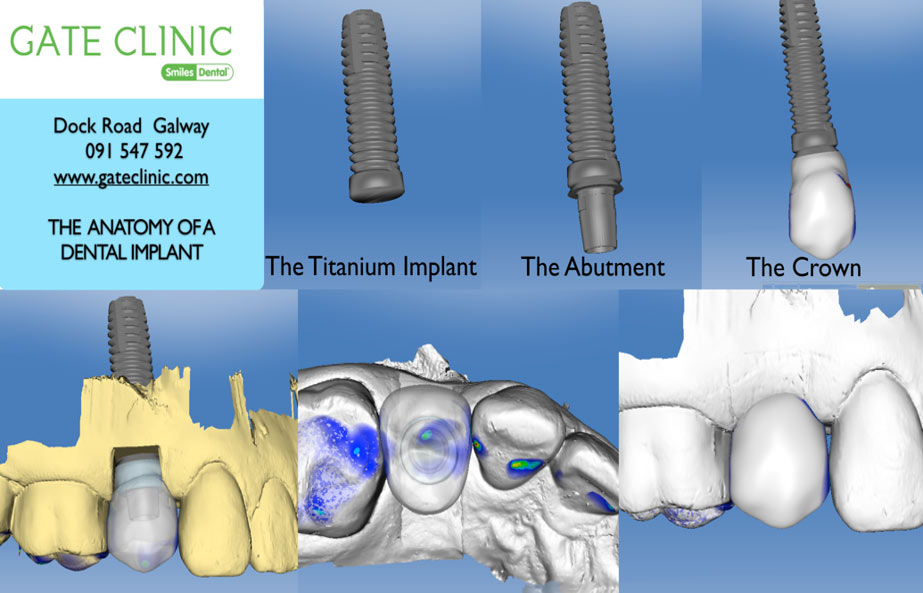 Dental Implants Procedure at Gate Dental Clinic Galway