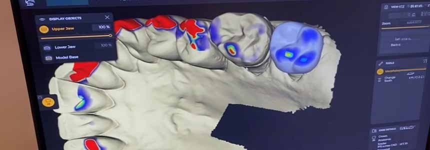 Gate InLab Design for Same Day Crowns